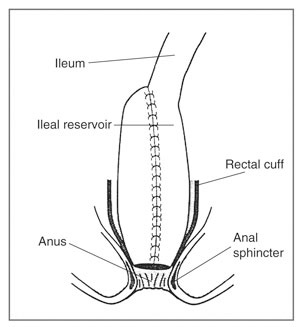 Ileoanal pouch Anastomosis