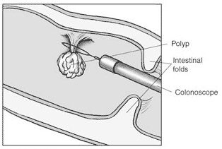 Polyp removal